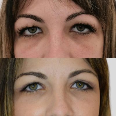 blefaroplastia antes y despues