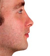 mentoplastia_despues