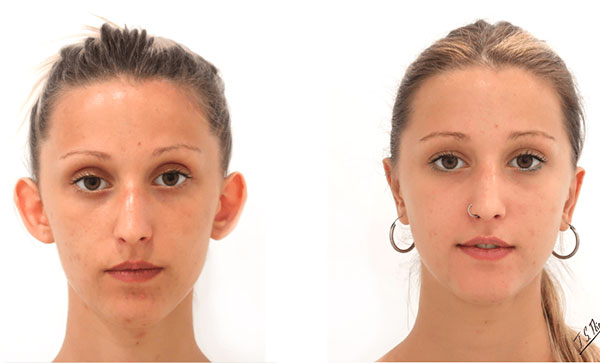 otoplastia barcelona