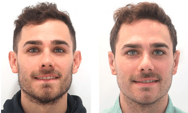 otoplastia barcelona