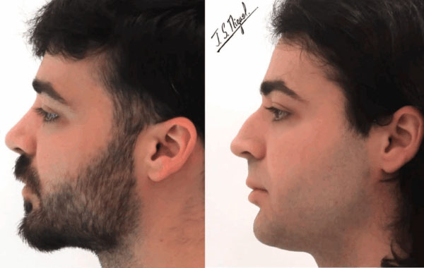 rinoplastia-ultrasonica