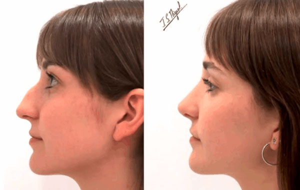 rinoplastia-ultrasonica_preservacion_ligamentos