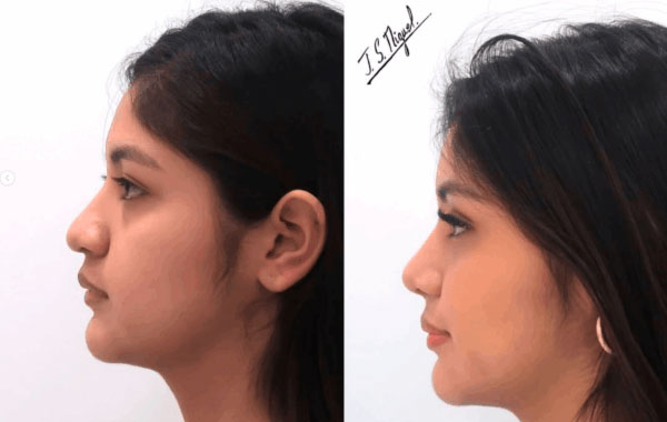 rinoplastia-ultrasonica_reseccion_bases_alares