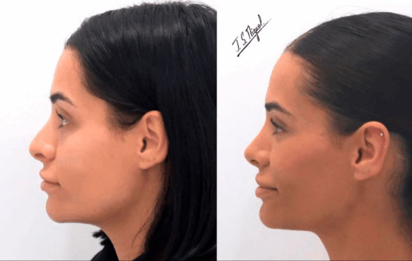 rinoplastia_ultrasonica